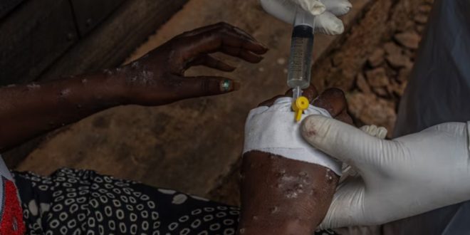 Mpox: les premiers vaccins arrivés en RDC, épicentre de l’épidémie