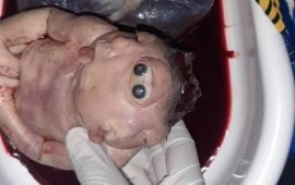 Siguiri: Naissance dt’un bébé qui porte une tête à 4 yeux, 2 nez à 4 narines et 2 bouches entièrement dentées à Léro