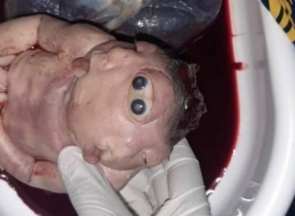 Siguiri: Naissance dt’un bébé qui porte une tête à 4 yeux, 2 nez à 4 narines et 2 bouches entièrement dentées à Léro